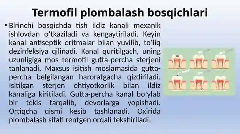 Ildiz kanallarining Termofil usulda plombalash 2