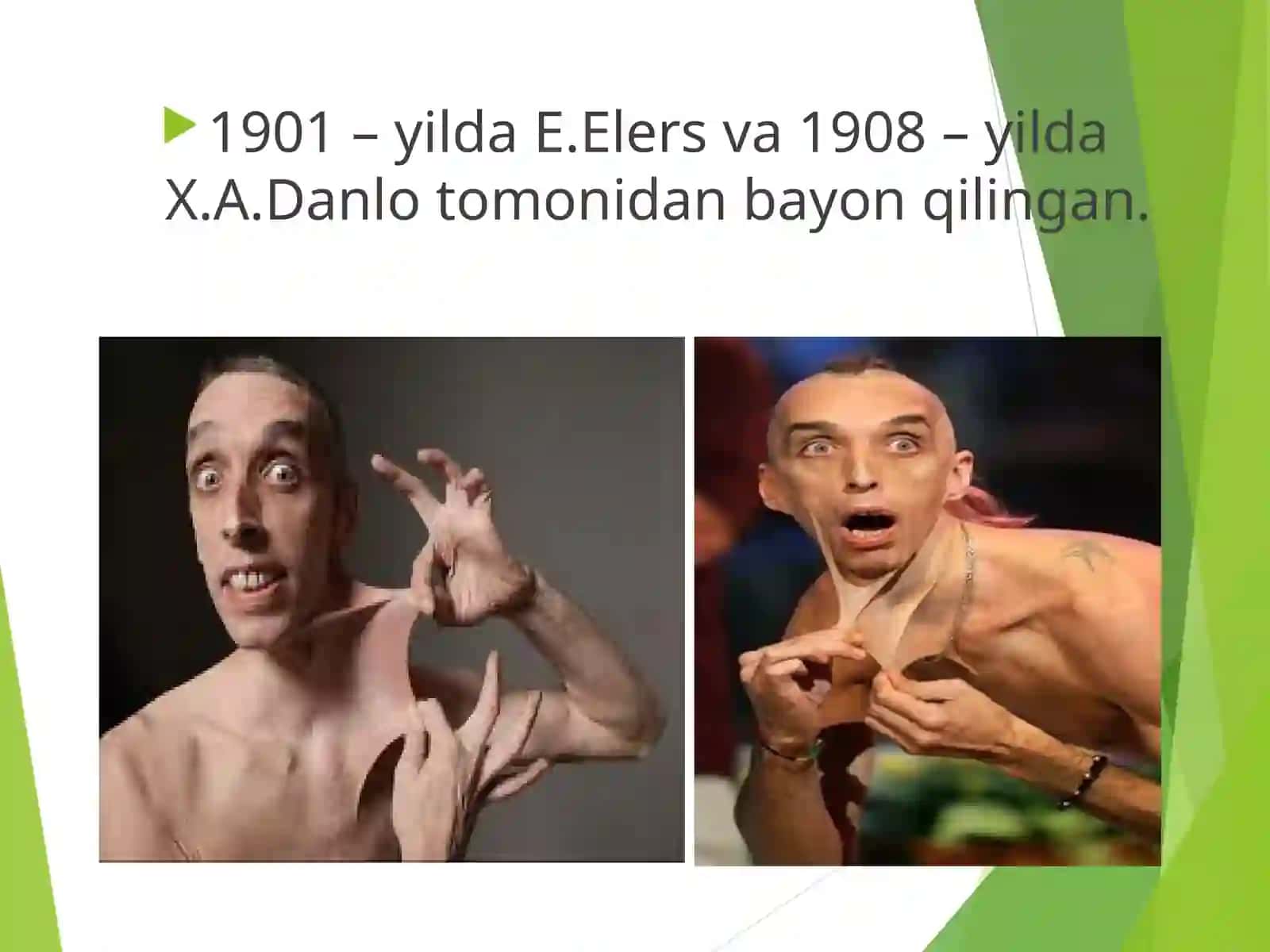 Elers – Danlo sindromi 2