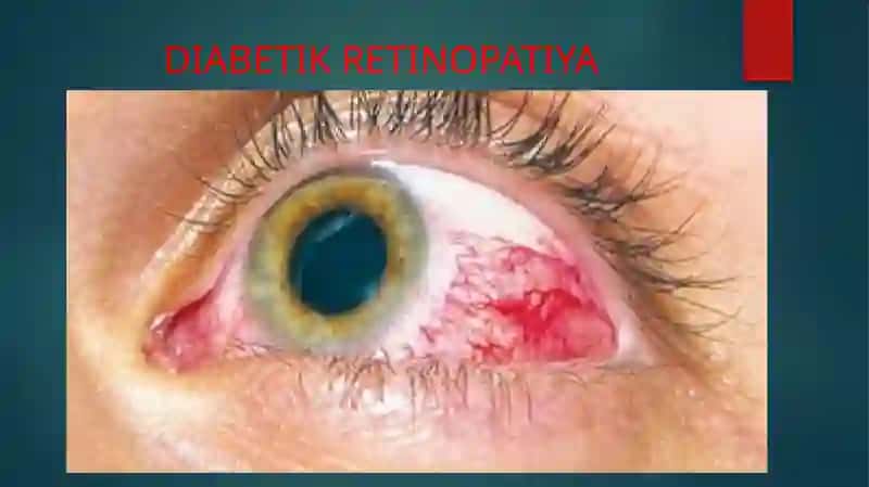 DIABETIK RETINOPATIYA 2