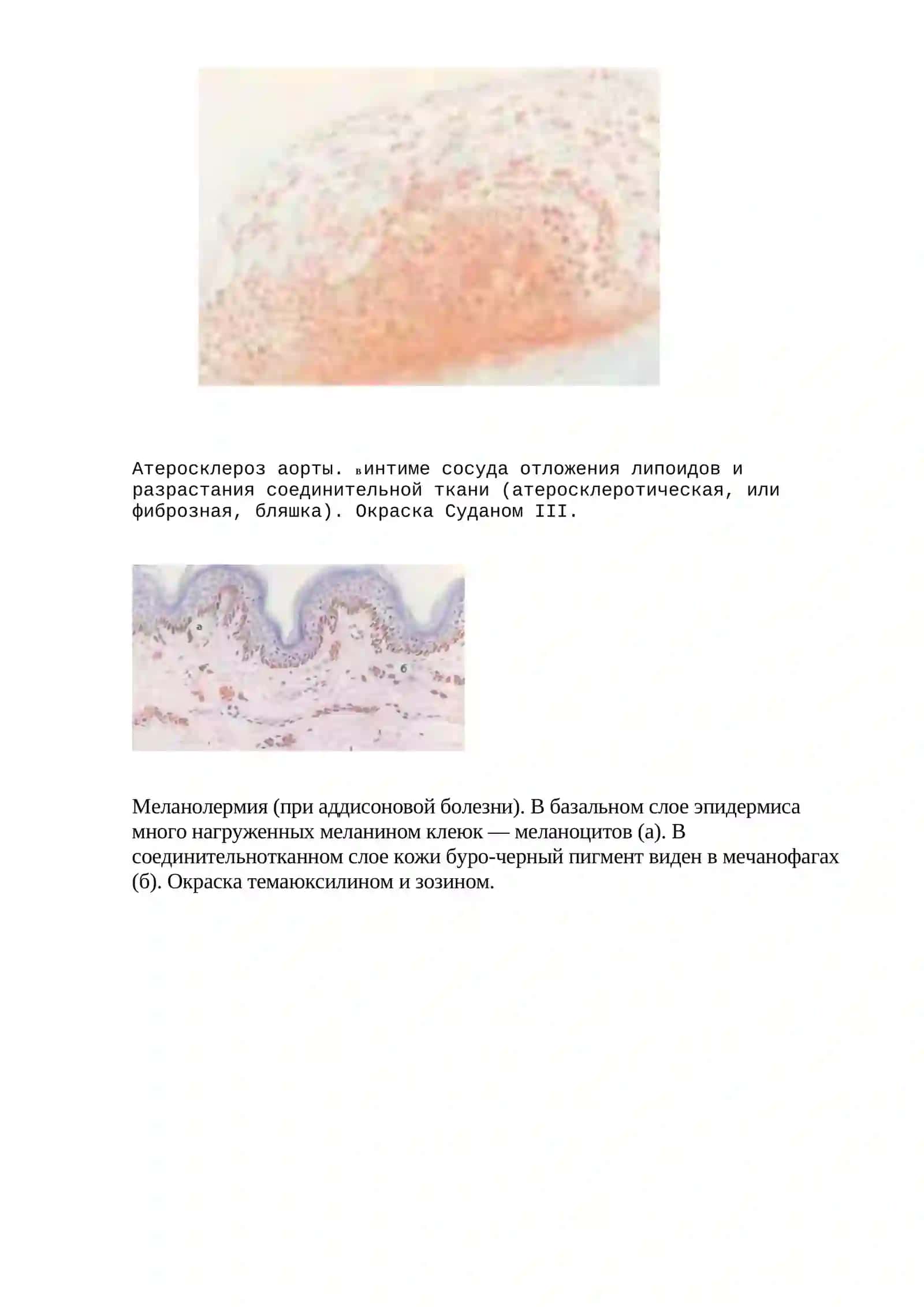 Атеросклероз аорты 2