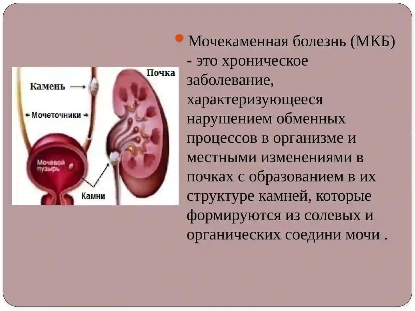 Мочекаменная болезнь 2