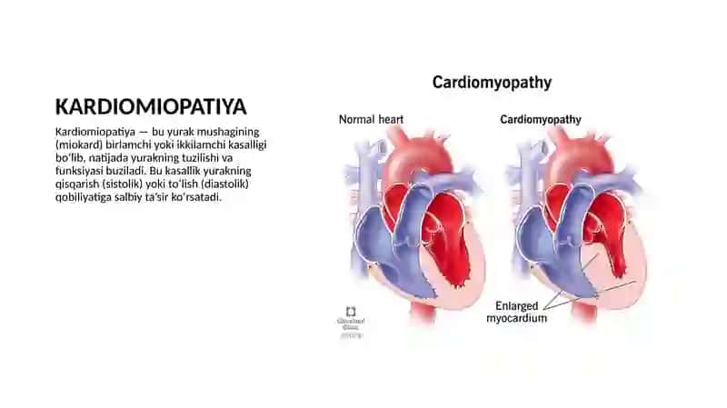 Kardiomiopatiya 2