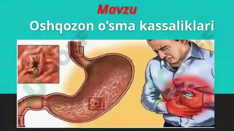 Oshqozon oʻsma kasalliklari 2