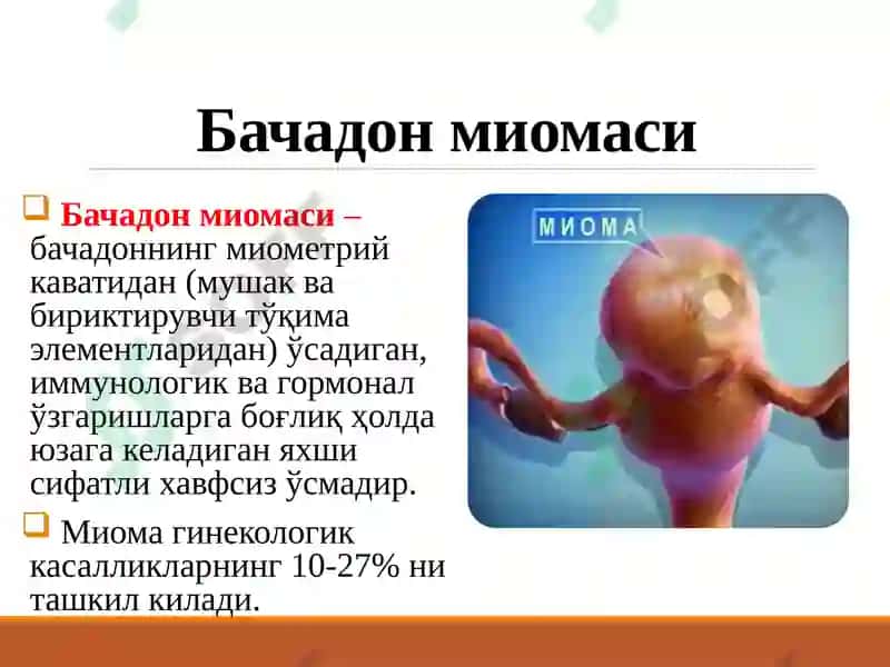 Bachadon  miomasi. endometrioz 2