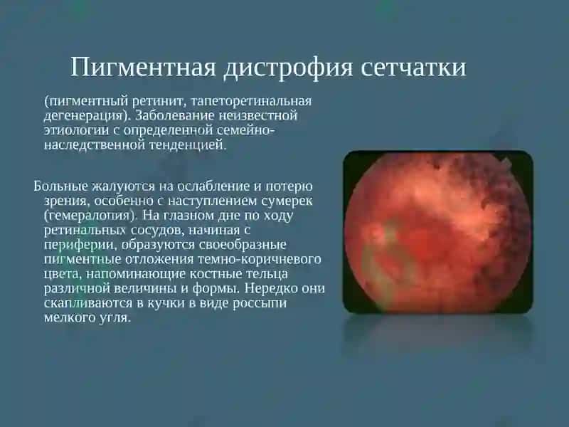 Пигментная дистрофия сетчатки 2
