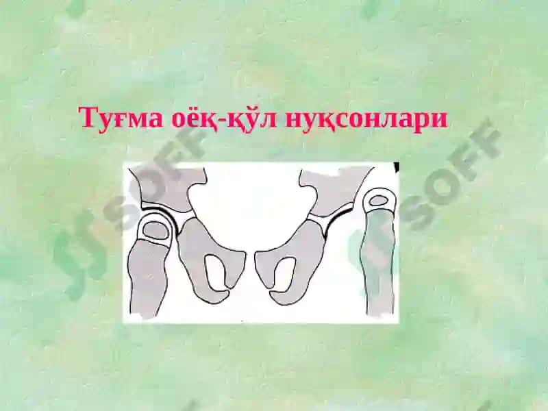 Туғма оёқ-қўл нуқсонлари 2