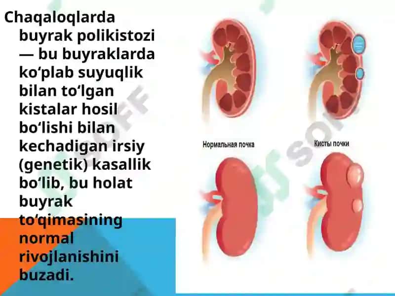 Buyrak polikistozi 2