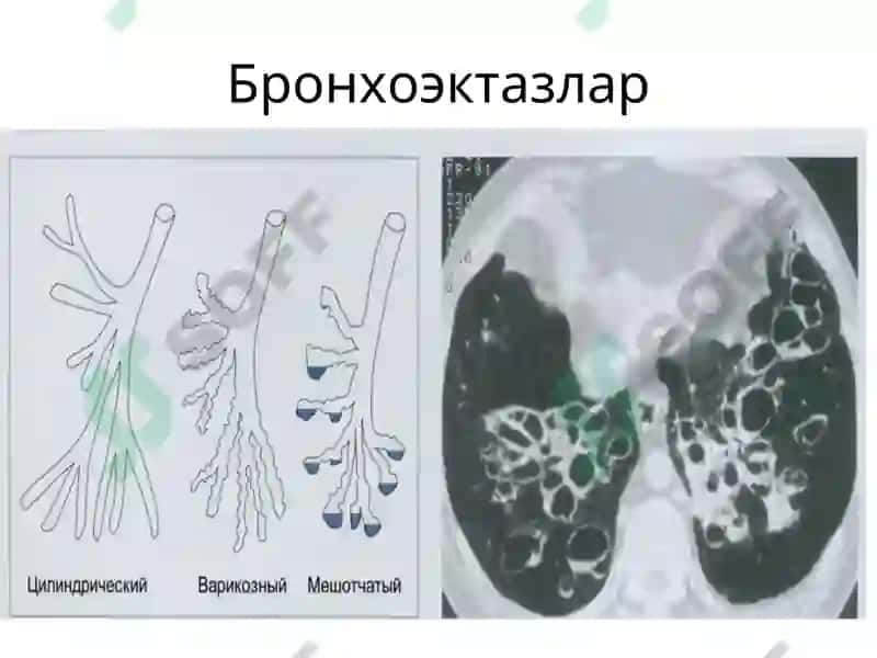 Бронхоэктазлар ва ўпка абсцесслари рентгенограммалари 2
