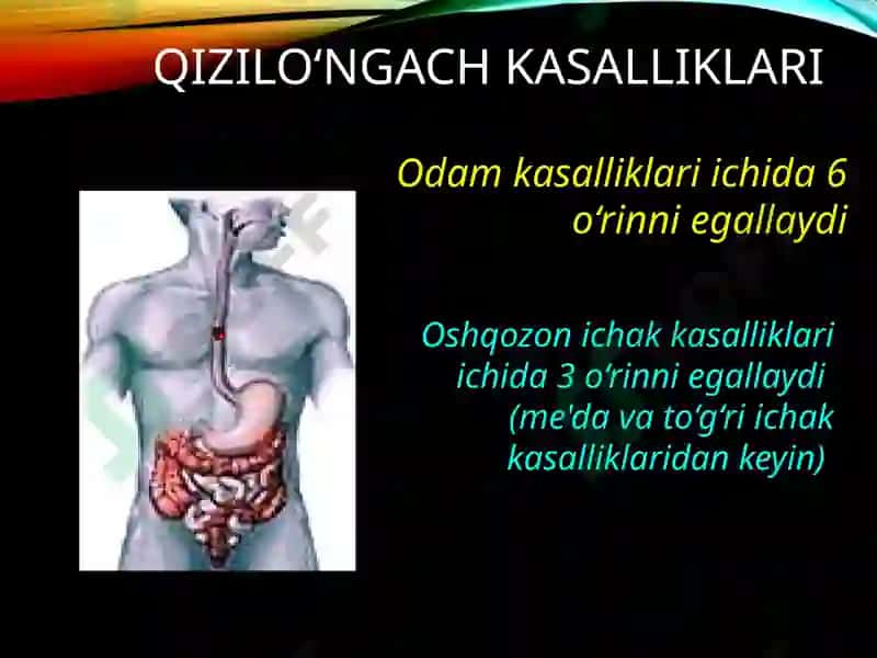 Qizilo’ngach kuyishi va yot jism 2