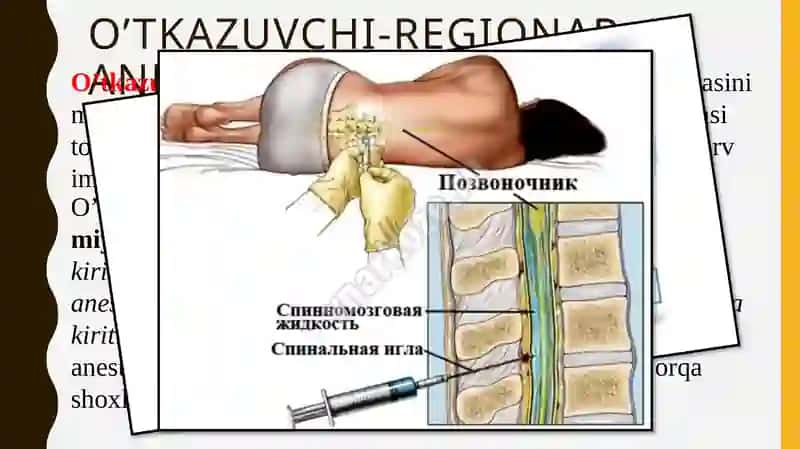 O’tkazuvchi-regionaranesteziya 2