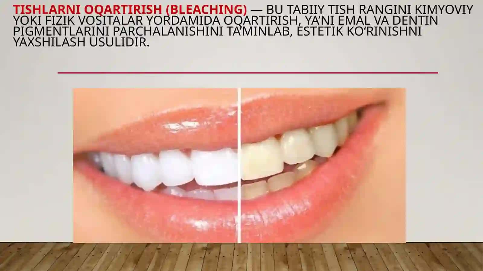 Tishlarni oqartirish 2
