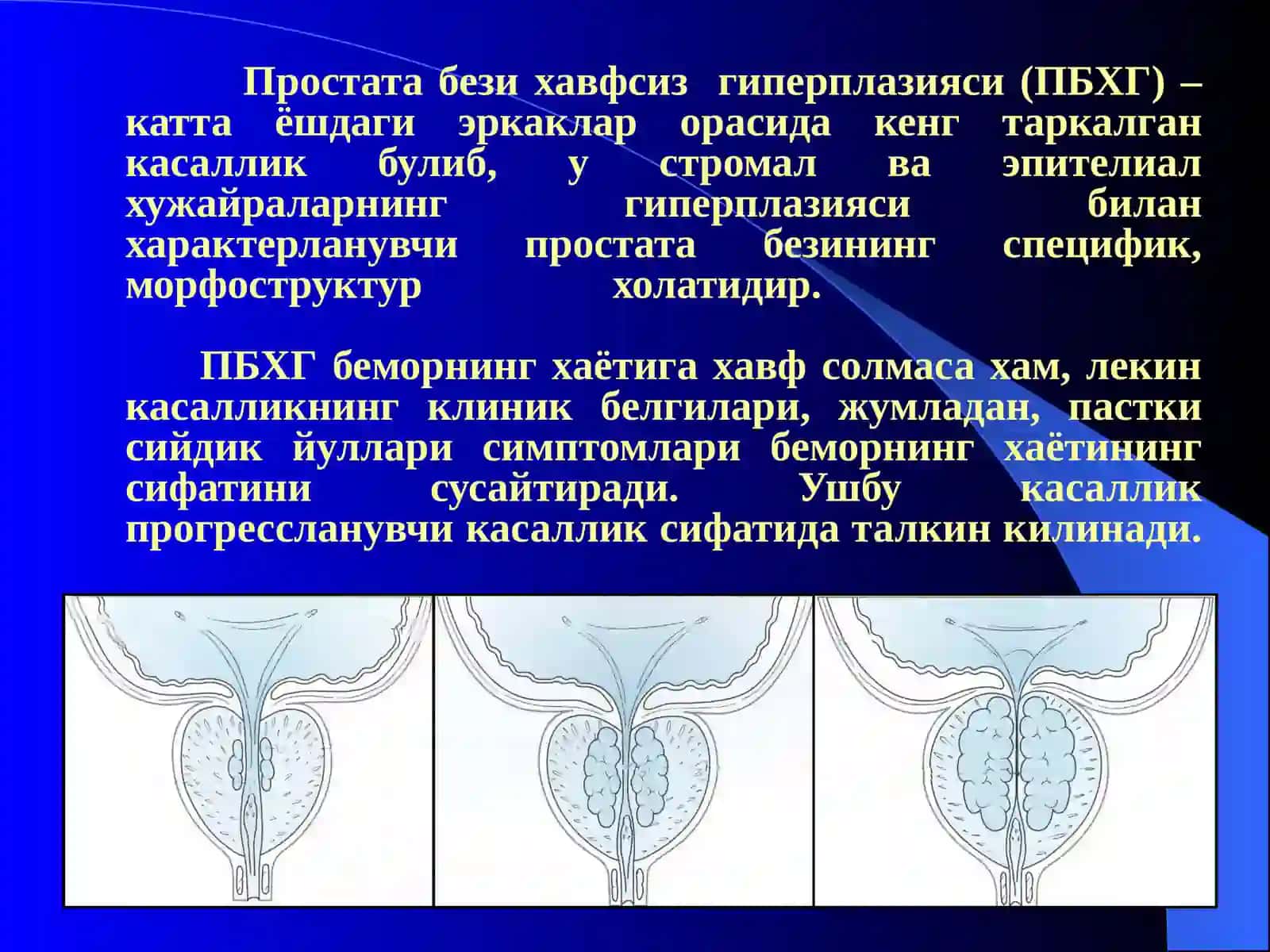 Простата бези хавфсиз гиперплазияси 2