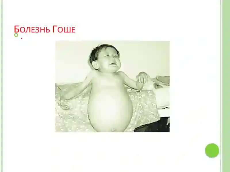 Врожденные заболевания обмена аминокислот 2