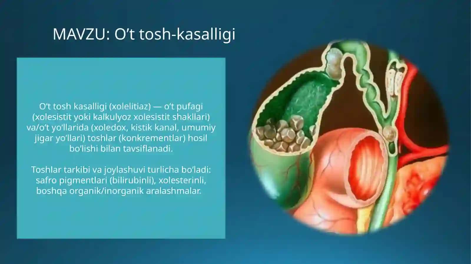 Oʻttoshkasalligi (Xolelitiaz) 2