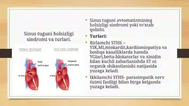 Sinus tugun holsizligi-zaifligi sindromi 2