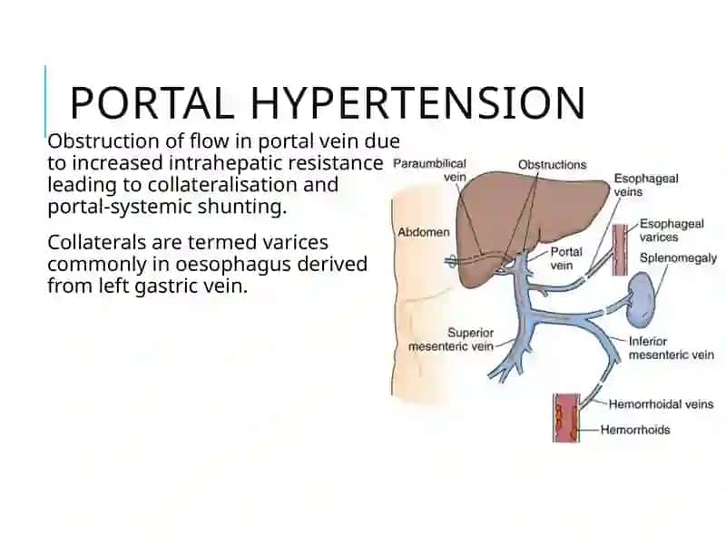 Portal Hypertension 2