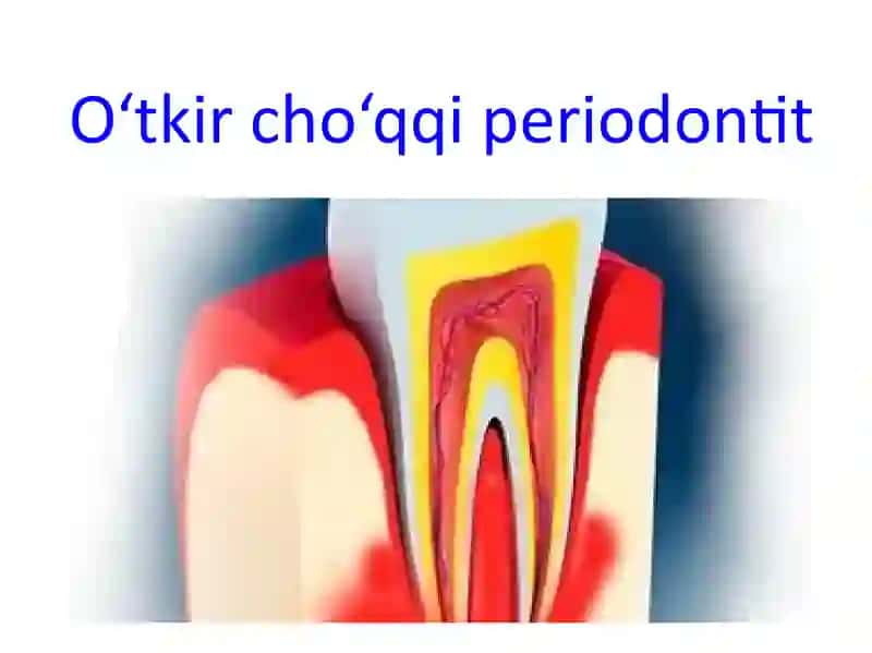 O‘tkir cho‘qqi periodontit 2