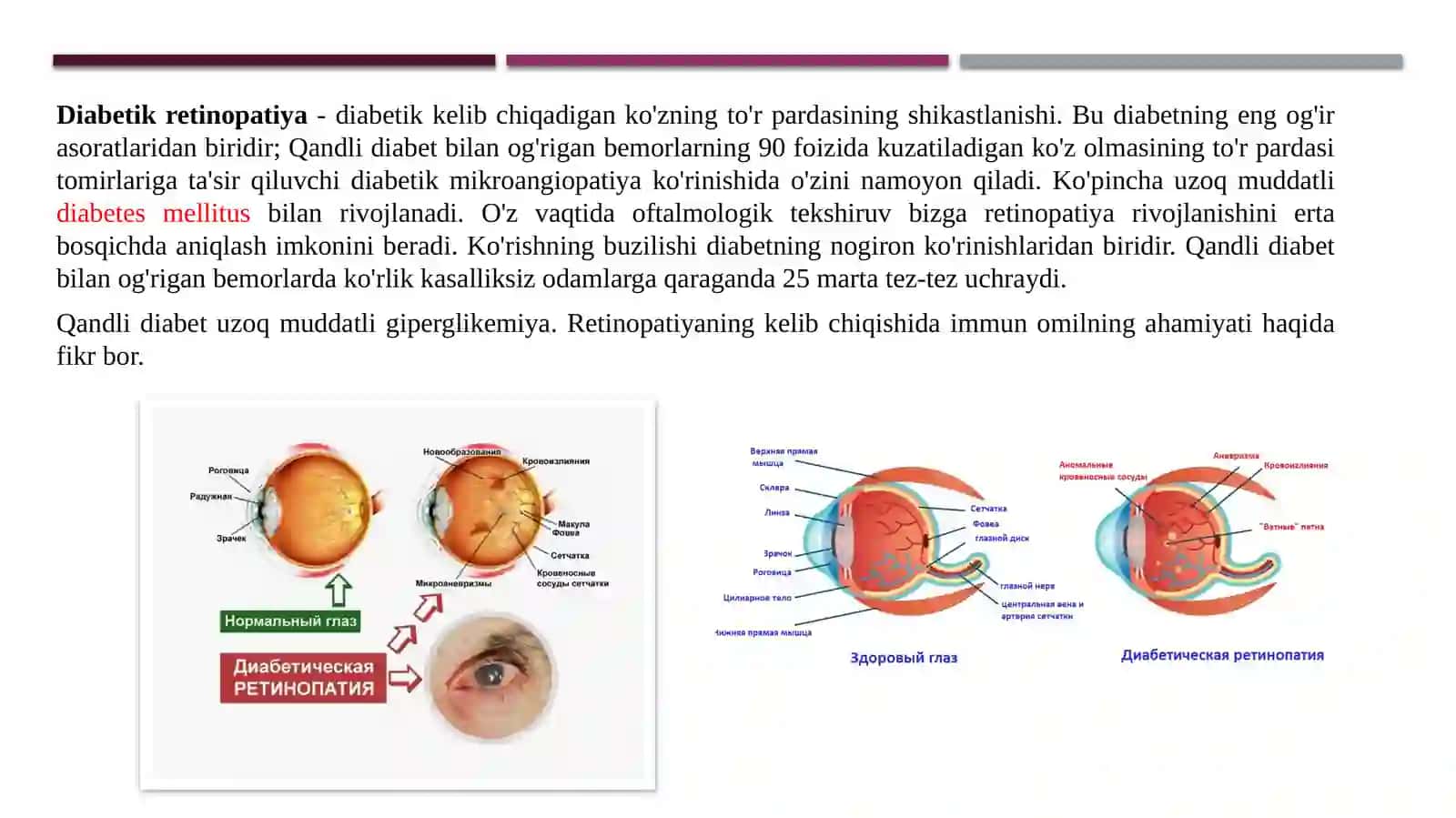 Diabetik retinopatiya 2