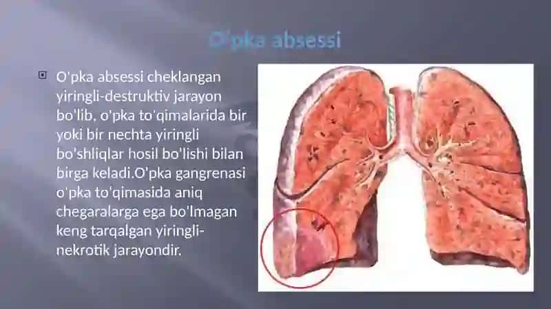 O‘pkada bo‘shliq sindromi (O‘pka absessi va bronxoektaz misolida) 2