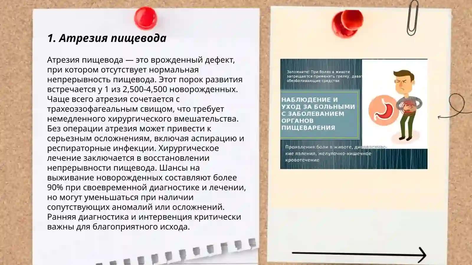 Атрезия пищевода 3