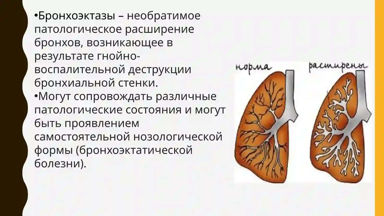 Бронхоэктатическая болезнь 3