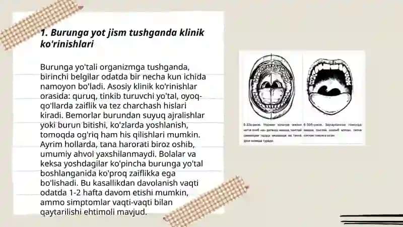 Burunga yot jism tushganda klinikasi,etiologiyasi, Differensial tashxis,va davolash 3