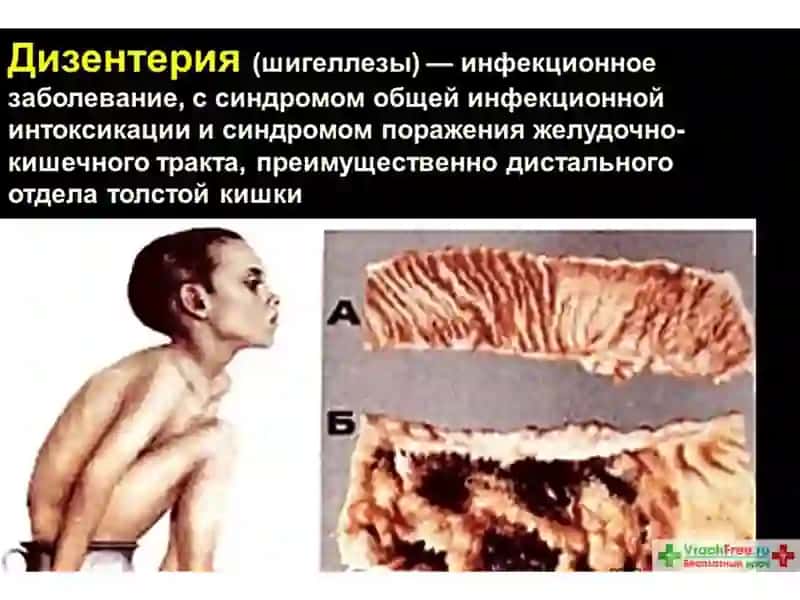 ШигеллезЫ 3