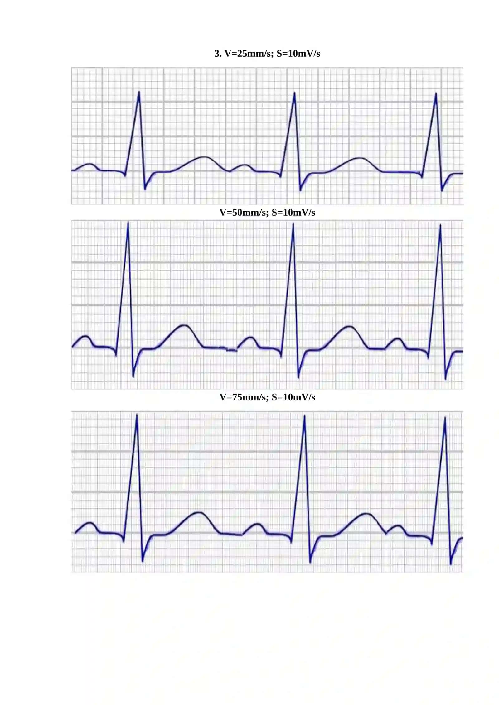 V=25mm/s; S=10mV/s 3