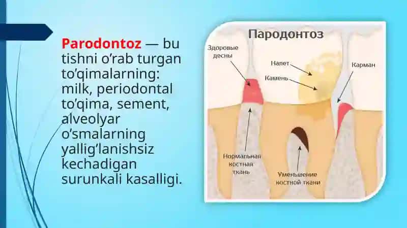 Parodontoz va uning sabablari 3