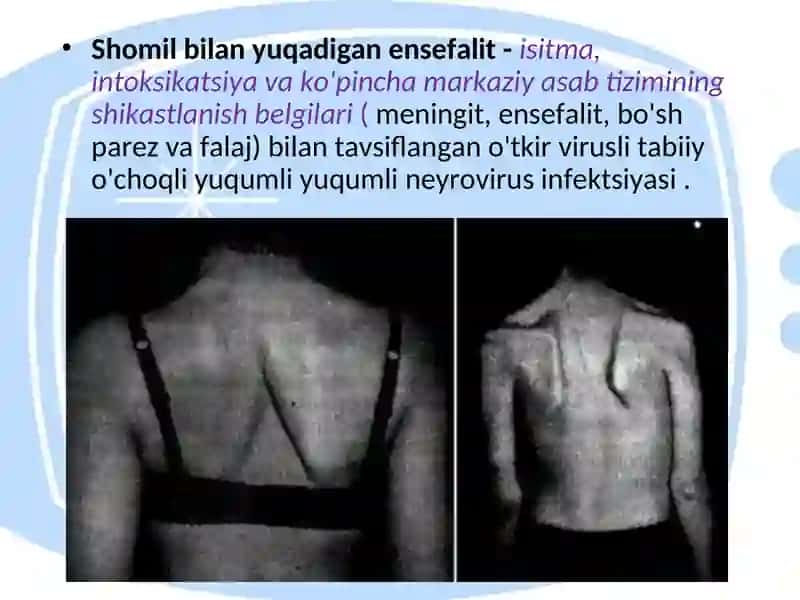 Ensefalit kasalligining kelib chiqish sabablari va asoratlari 3