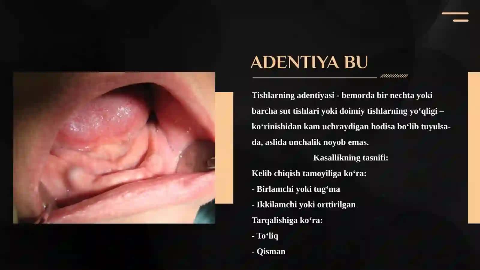 Ko‘p sonli birlamchi  adentiya va uning  tashxislash yo‘llari.  Angidrotik ektodermal displaziya. 3
