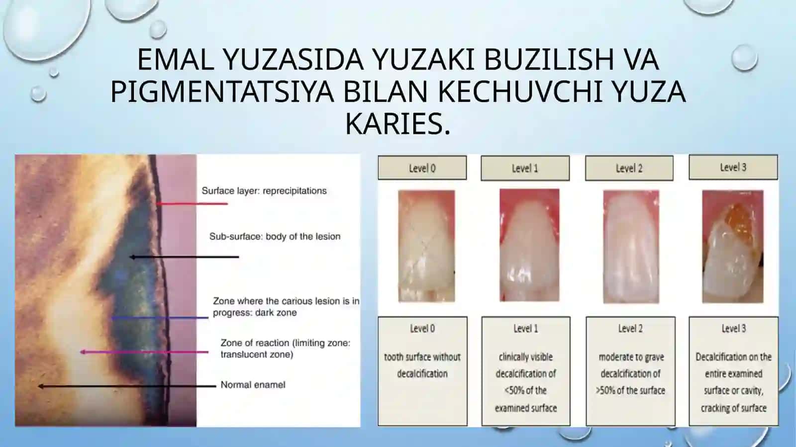 YUZA KARIES VA BOSHLANG‘ICH KARIESNI QIYOSIY TASHHISLASH 3