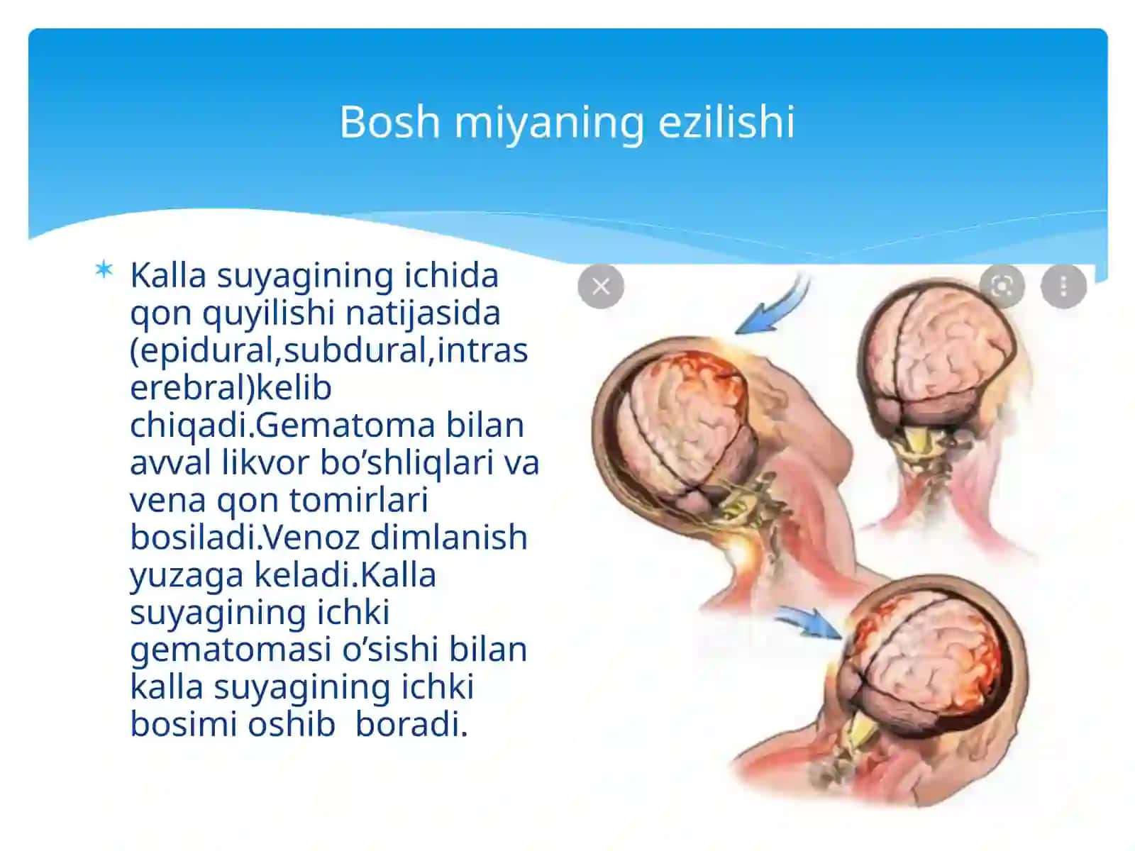 Bosh miya travmalari.Radiologik ko'rinishlar 3