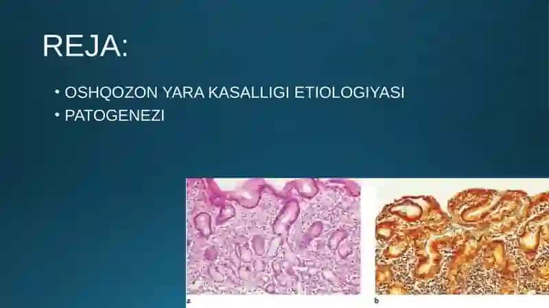 OSHQOZON YARA KASALLIGI ETIOPATOGENEZI 3