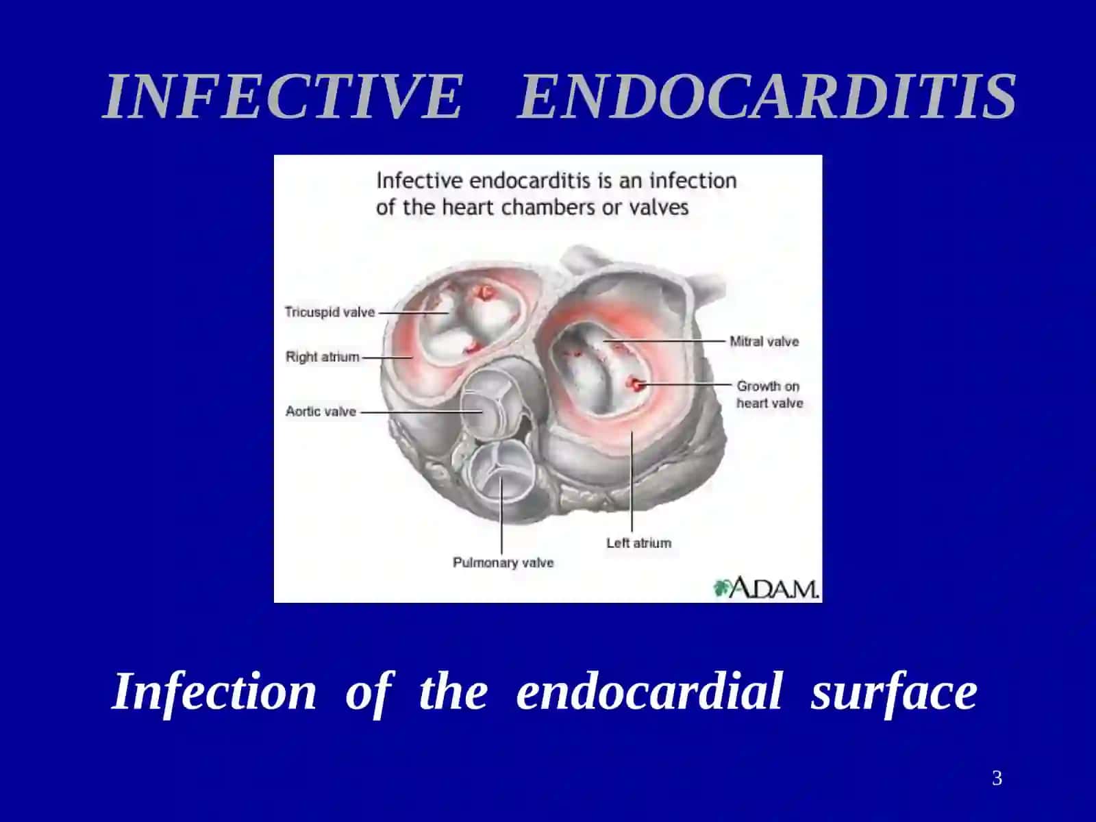 INFECTIVE ENDOCARDITIS 3