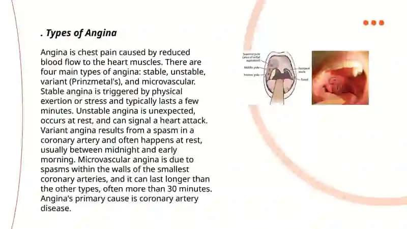Angina 3