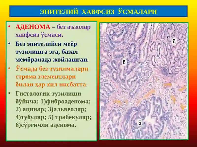 ПАТОЛОГИК АНАТОМИЯ “Ўсмалар. Мезенхимал ўсмалар” 3