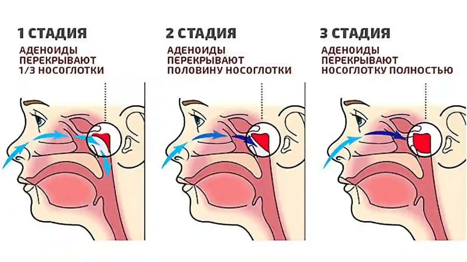 HALQUM MURTAGI GIPЕRTROFIYASI 3