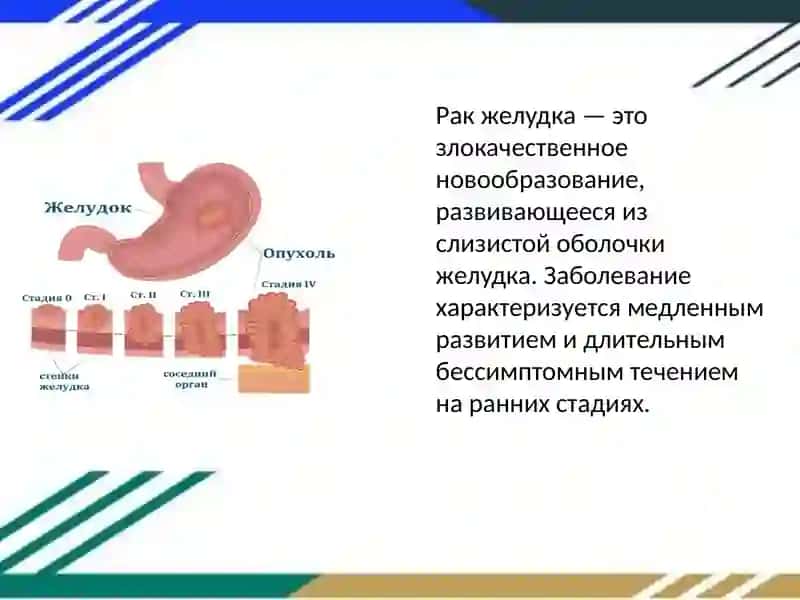 Рак желудка 3
