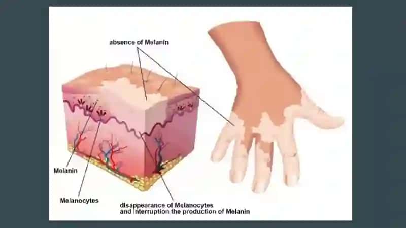VITILIGO va  UNING ZAMONAVIY DAVOLASH USULLARI 3