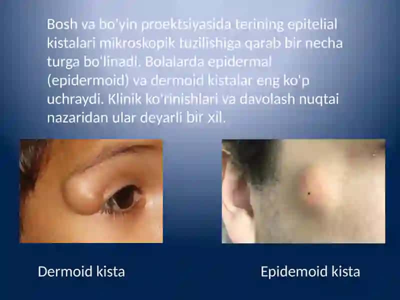 Epidermoid va dermoid kistalar tashxisi va davolashi 3