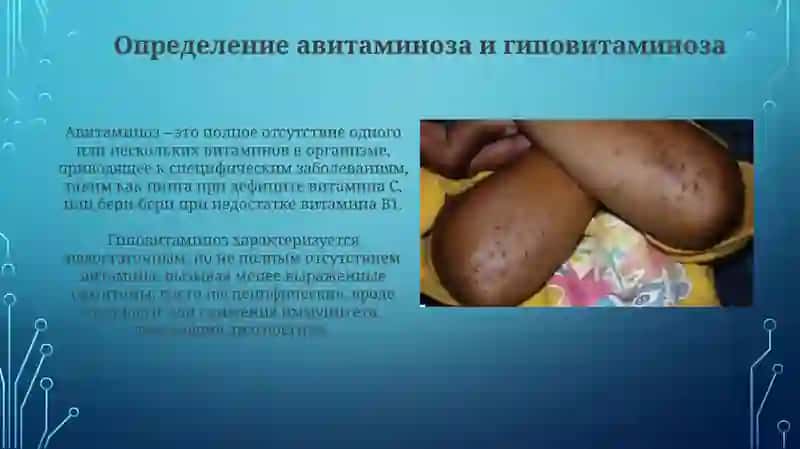 Авитаминоз и гиповитаминоз 3