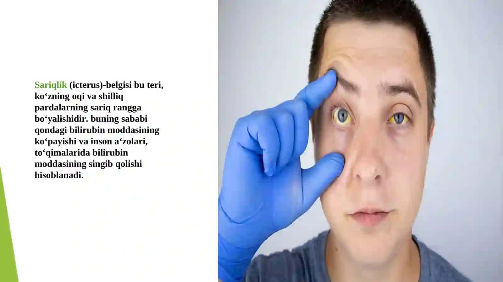 Sariqlikning biokimyoviy jihatdan differensial tashxisi 3