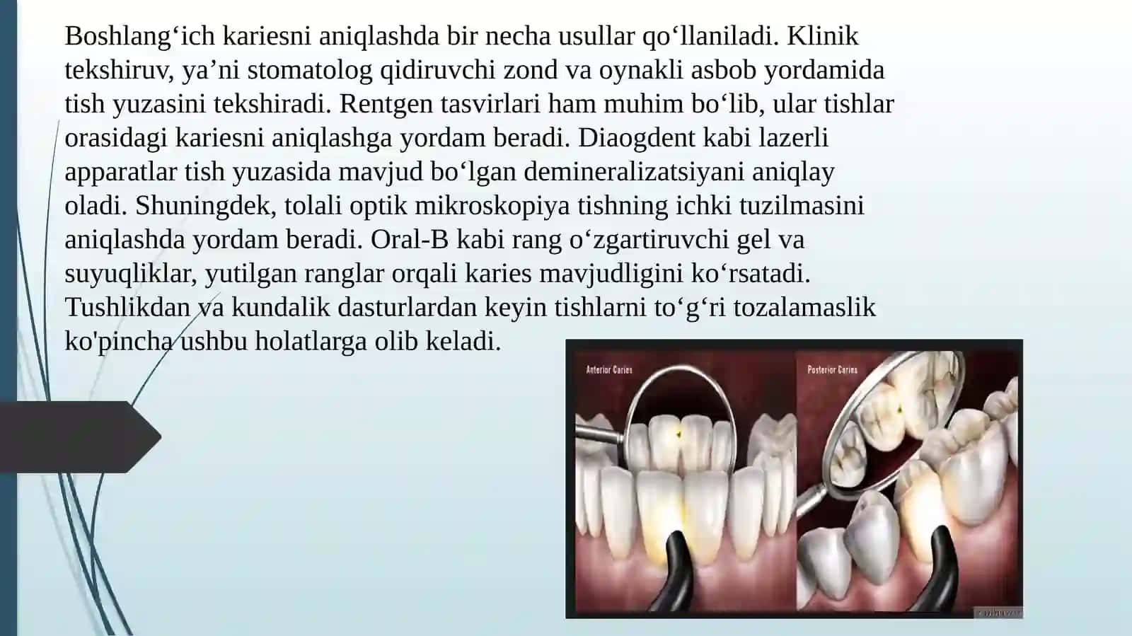 Boshlangʻich (oq dogʻ davri) va yuza kariesni (ekzogen) va (endogen) davolash usullari 3