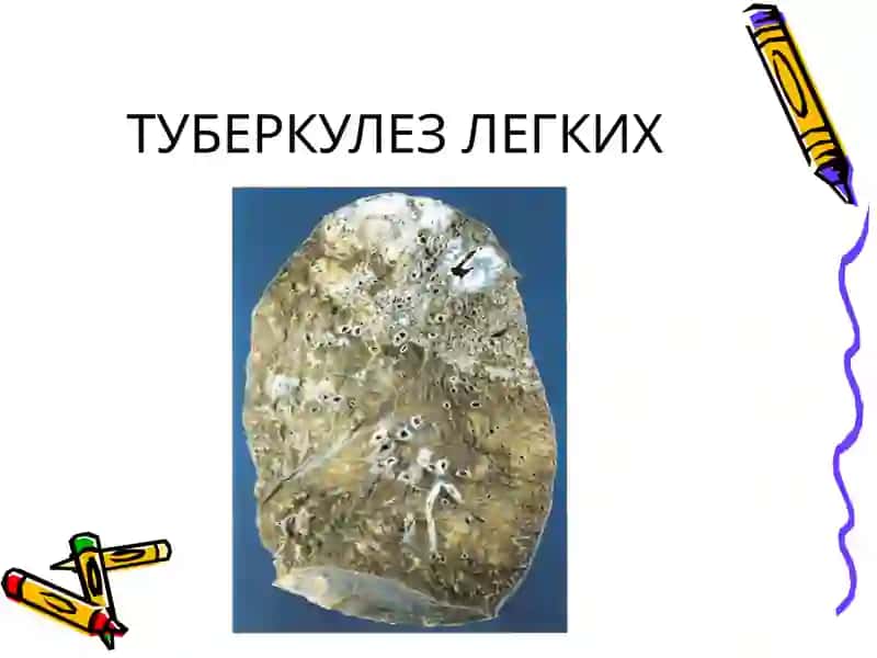 Туберкулез Лекция 3