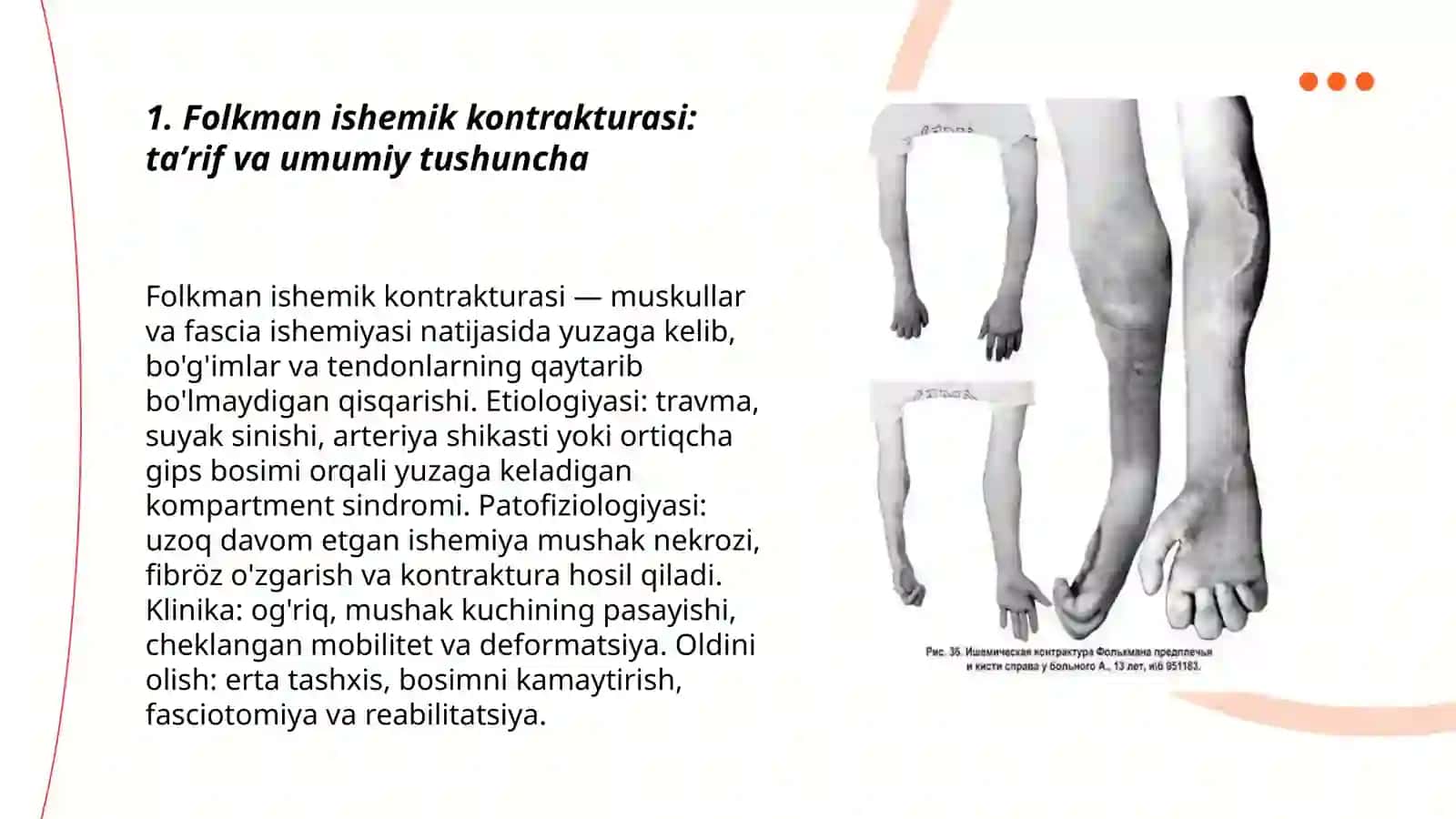 Folkman ishemik kontrakturasi 3