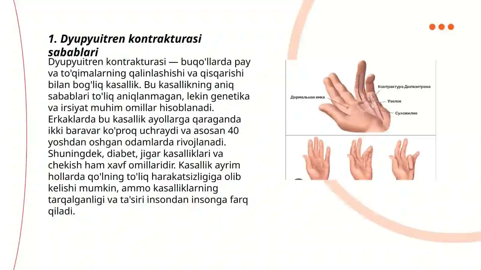 Dyupyuitren kontrakturasi 3
