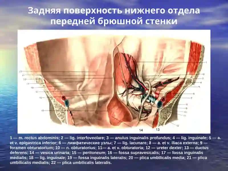 Паховые, пупочные, бедренные грыжи 3