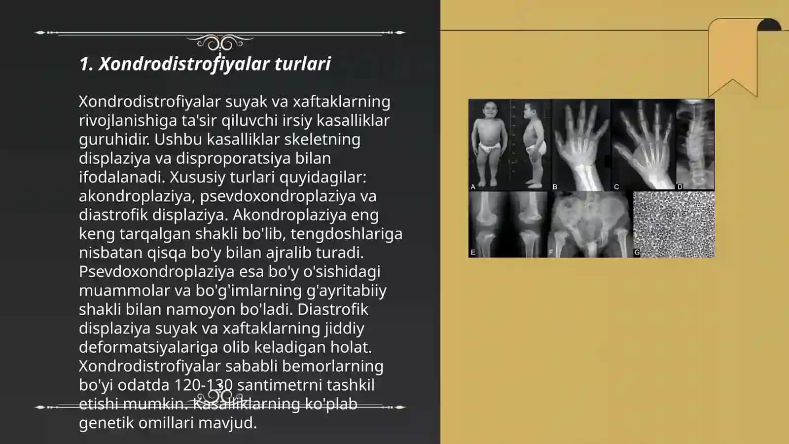 Xondrodistrofiyalar 3