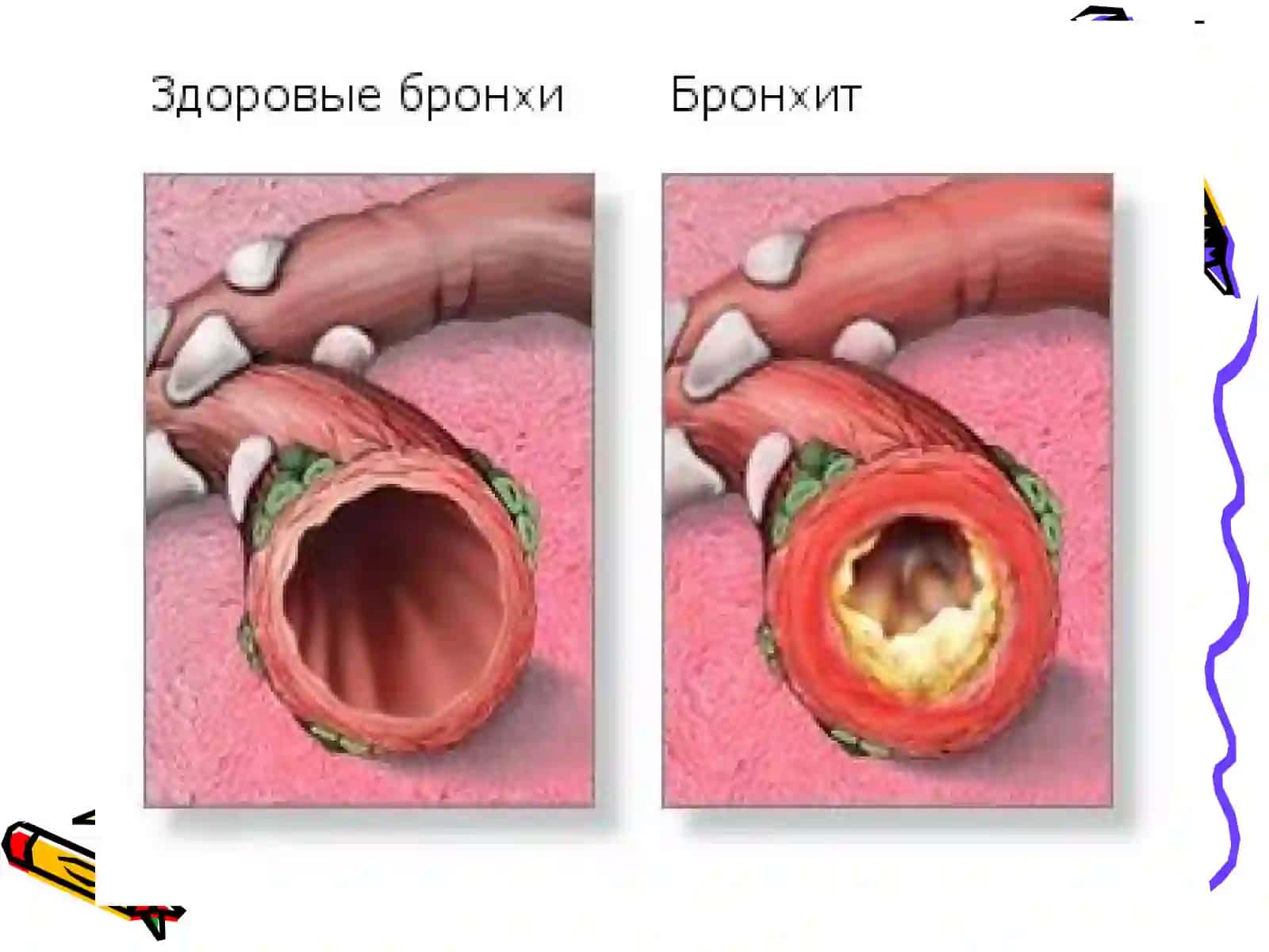 Болаларда Бронхитлар 3